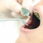 奥歯をセラミックの白い歯に保険適用の２つの条件｜歯医者さんの探し方