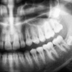 親知らず抜歯1ヶ月後に化膿で激痛体験ブログ「ドライソケットでない」と診断