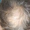 エドガーケイシー療法でハゲ薄毛を発毛中｜ひまし油パック自作・原油シャンプー・ジャガイモ皮
