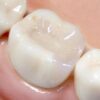 仮歯（差し歯）を自分で作った個人体験談ブログ｜自作の歯の材料と接着剤